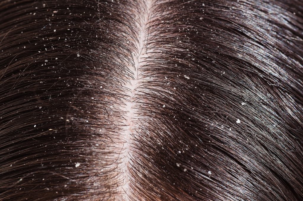 apple cider vinegar dandruff remedy