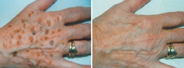 Apple cider vinegar removes age spots
