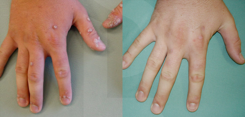 Apple Cider Vinegar Wart Remover