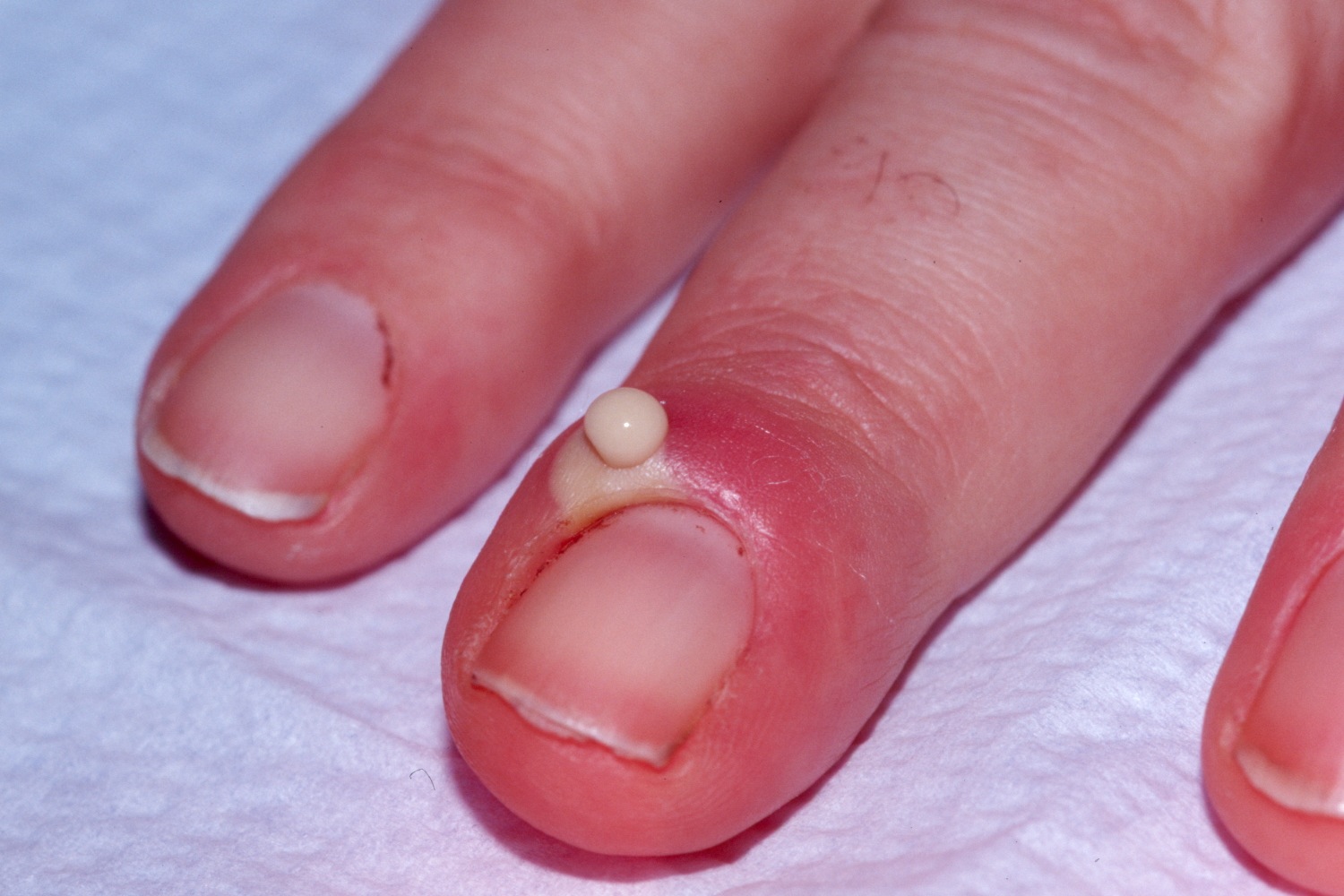 Redness of the nail bed caused by infection - wide 2