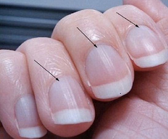 Causes of Dark Colored Nail Beds - wide 2